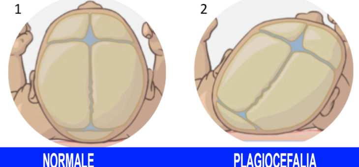 Plagiocefalia e Osteopatia