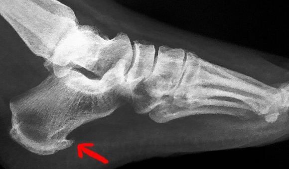 Spina Calcaneare