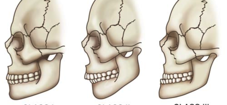 Malocclusione e postura