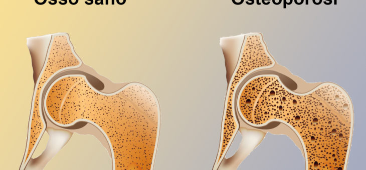 Osteoporosi