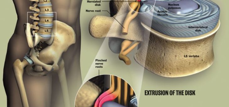ERNIA DISCALE E DOLORE ALLA SCHIENA